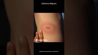 Erythema Migrans [upl. by Ilenay]