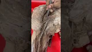 Dissection of gluteal region ⚕️anatomy dissection treandingyoutubevideoanatomymedstudent [upl. by Drofub138]