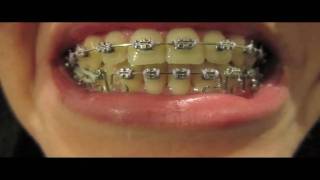 Braces Update  15 One molar elastic [upl. by Sparks]