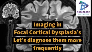 Imaging in focal cortical dysplasiasLets diagnose them confidentlyTransmantle signEpilepsy MRI [upl. by Pubilis382]