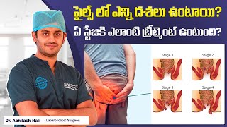 పైల్స్ లో దశలు amp చికిత్స  Best Treatment for Piles in Telugu  Stages of Piles  Dr Abhilash Nali [upl. by Adah133]