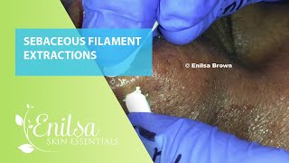 Sebaceous Filament Extractions [upl. by Webb]