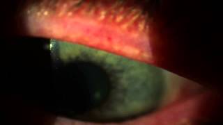 Keeler H5 Slit Lamp  Dry Eye Exam HD No Sound [upl. by Dorsman]