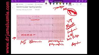 Ventricular tachycardia Dr Jamal USMLE  cardiology ECG lecture [upl. by Jeanette]