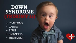 What is Down Syndrome Trisomy 21 Down syndrome Trisomy 21 Made Easy [upl. by Hoes]