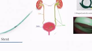 Ureteral Stent [upl. by Brinson]