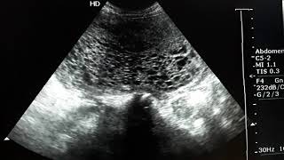 Molar pregnancy ultrasound imageRadiology [upl. by Nede443]