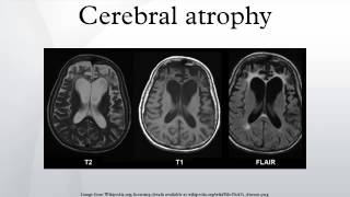 Cerebral atrophy [upl. by Eniffit10]