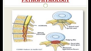 Spinal Stenosis  Medical PowerPoint Presentation [upl. by Gherardo]