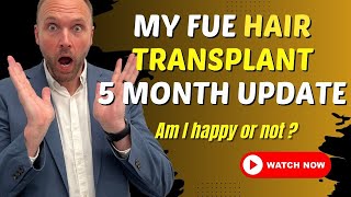 My FUE Hair Transplant 5 Months Update Am I happy or not [upl. by Ykcin137]