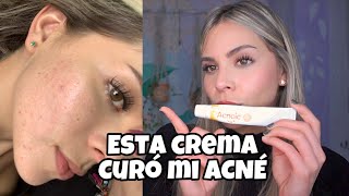 CREMA CURÓ MI ACNÉ acnoic gel peroxido de benzoilo y adapaleno [upl. by Doniv930]