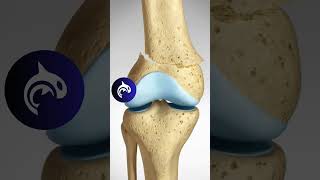 See how a Supracondylar Fracture of the Knee and Surgical Fixation works in 3D Animation [upl. by Nnylirret]