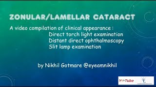 ZonularLamellar Cataract [upl. by Binnings50]