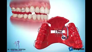 Anterior Crossbite Appliance  Dr Tzortzi [upl. by Eibbil40]