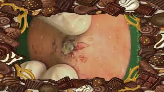 BEST Pimple Popping💖💖 blackheads2023 bestpimplepopping [upl. by Sima]