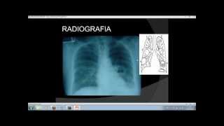 absceso pulmonar  diagnostico radiologico tto [upl. by Artema661]