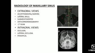 Maxillary sinus imaging and sinusitis [upl. by Alistair400]