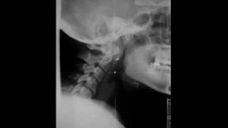 ArnoldChiari Malformation [upl. by Orit]