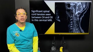 Internal tremors whole body vibrations amp the connection to neck instability amp spinal cord tension [upl. by Shipman515]