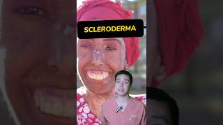 How to operate SCLERODERMA surgeonph viralvideo viralshorts fyp foryou foryoupage scleroderma [upl. by Hymie]