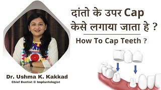 दांतो के उपर Cap केसे लगाया जाता हे   How To Cap Teeth   Summirow Dental [upl. by Sy342]