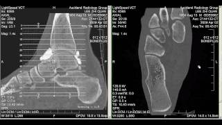 CT Arthrogram of my Ankle 2 April 2009 [upl. by Aneelehs]