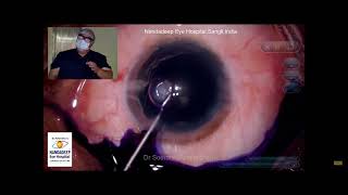 CAPSULASER Fibrosis with Pupil Expander [upl. by Vivyanne]