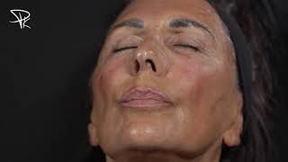 Le rajeunissement facial  Technique et injections Pratique  Injections de fillers [upl. by Nillok]