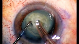 Phaco Chop Mastery Horizontal and Vertical for Safe Cataract Surgery [upl. by Guzel]