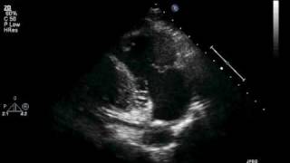 Transthoracic ECHO Parasternal Long RV Inflow View [upl. by Nelrsa920]