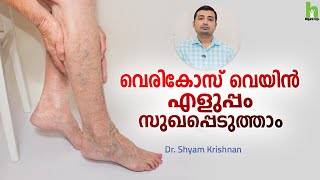 വെരികോസ് വെയിൻ കാരണങ്ങളും ചികിത്സയും  Varicose veins Malayalam Health Tips  Arogyam [upl. by Holms630]