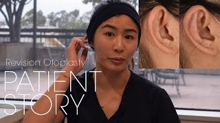 Revision Otoplasty For Prominent Ear Correction  Ear Fold Surgery Patient Testimonial [upl. by Neelav]