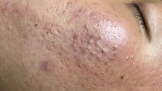 ACNE TREATMENT VU QUYNH MI  Blackheads On Boy Face 2024FULL [upl. by Neil]