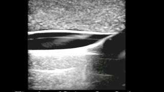 Saphenovenous Ablation Ultrasound Training Model [upl. by Wehttam442]