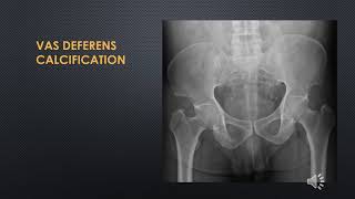 کلسیفیکاسیون شکمی abdominal calcification radiology [upl. by Dowzall]