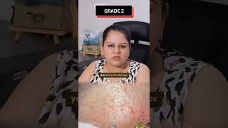 UNDERSTANDING ACNE GRADES acneexpert acnetreatment acneremoval acnescarstreatment skincare [upl. by Sidwell]