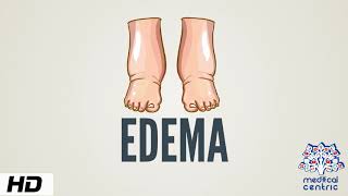 Edema Causes Signs and Symptoms Diagnosis and Treatment [upl. by Laeynad]