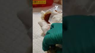 Sac of 10 year old cyst that was removed [upl. by Qahsi]