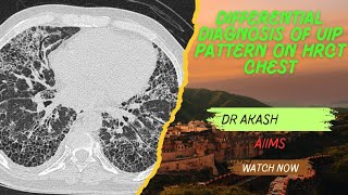 UIP Pattern  Differentials  HRCT Chest ild doctor medicalstudent neet mbbs [upl. by Irahc]