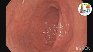 Candida oesophagitis l l Endo Cut [upl. by Hayimas]