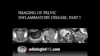 Imaging of Pelvic Inflammatory Disease Part I [upl. by Nahsad]