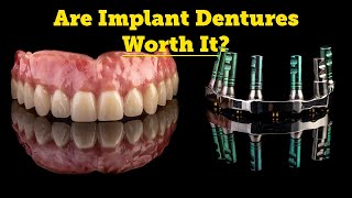 Denture FAQs  Types of Implant Dentures SnapOn Dentures [upl. by Lladnor130]