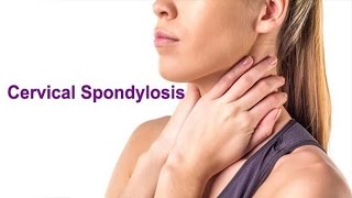 CERVICAL SPONDYLOSIS [upl. by Ackler]