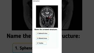 🔍 Anatomy Quiz🔍 Comment your answer belowRadiologyBuzz SinusAnatomy RadiologyQuiz [upl. by Alli]