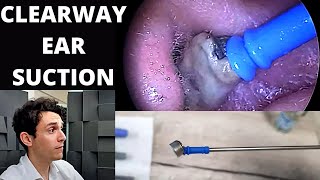 Soft Tip Suction Probe Used to Extract Dead Skin From Ears Clearway Suction Tool [upl. by Bouzoun]