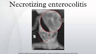 Necrotizing enterocolitis [upl. by Deery]