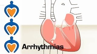 Arrhythmias  What is an arrhythmia and how is it treated [upl. by Ronoh]