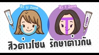 Beauty Story  สิวต่างโซน รักษาต่างกัน สิวอุดตัน  สิวอักเสบ  สิวหนอง [upl. by Esinehs]