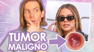 KHLOE KARDASHIAN tiene un TUMOR EN LA CARA  Todo sobre su tumor maligno  Simon Scarano Dermatologo [upl. by Neik]