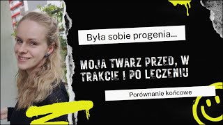 Porównanie końcowe twarz przed w trakcie i po [upl. by Iadrahs]